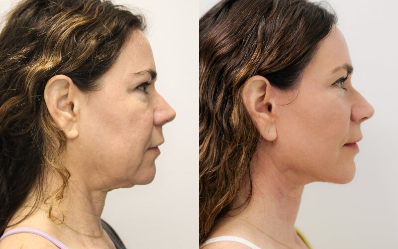 Facelift before and after - after