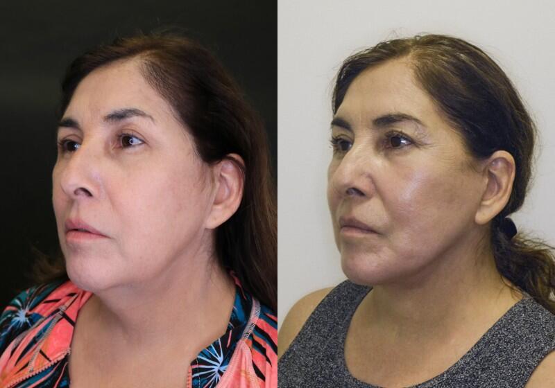 Facelift before and after - after