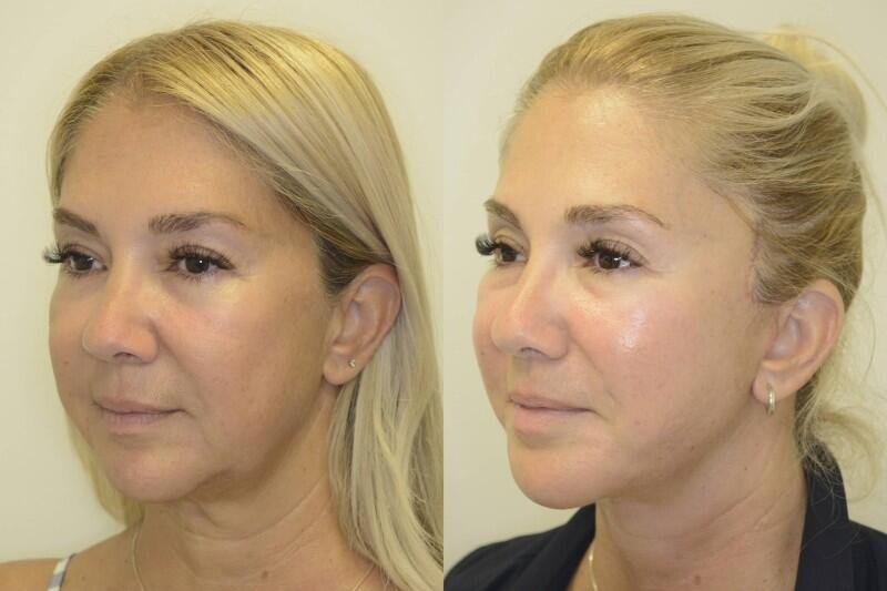 Facelift before and after - after