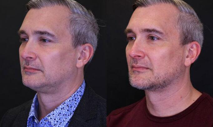 Liposuction before and after - after