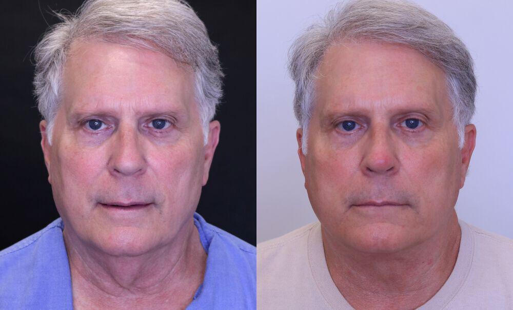 Neck Lift before and after - after