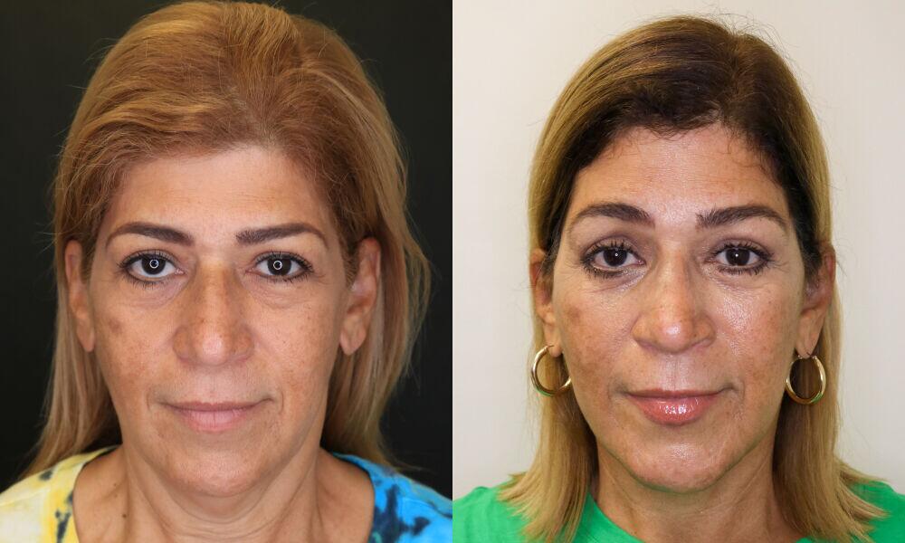 Neck Lift before and after - after