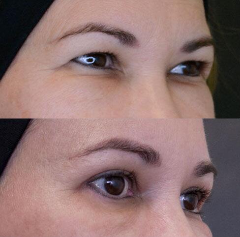 Blepharoplasty before and after - after
