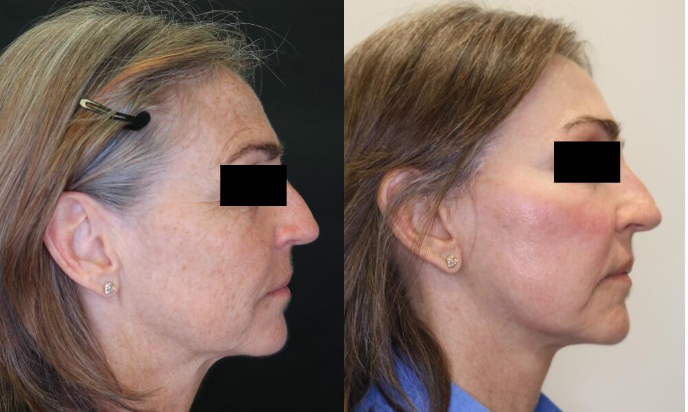 Facelift before and after - after