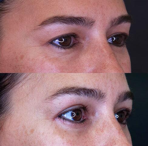 Blepharoplasty before and after - after
