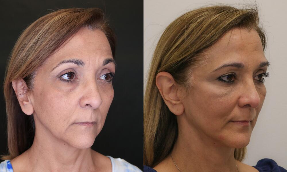 Facelift before and after - after