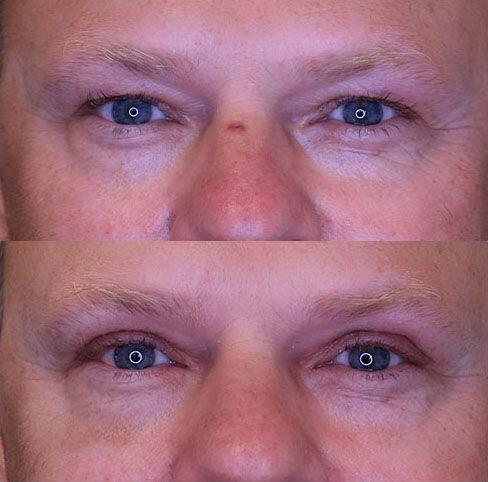 Blepharoplasty before and after - after