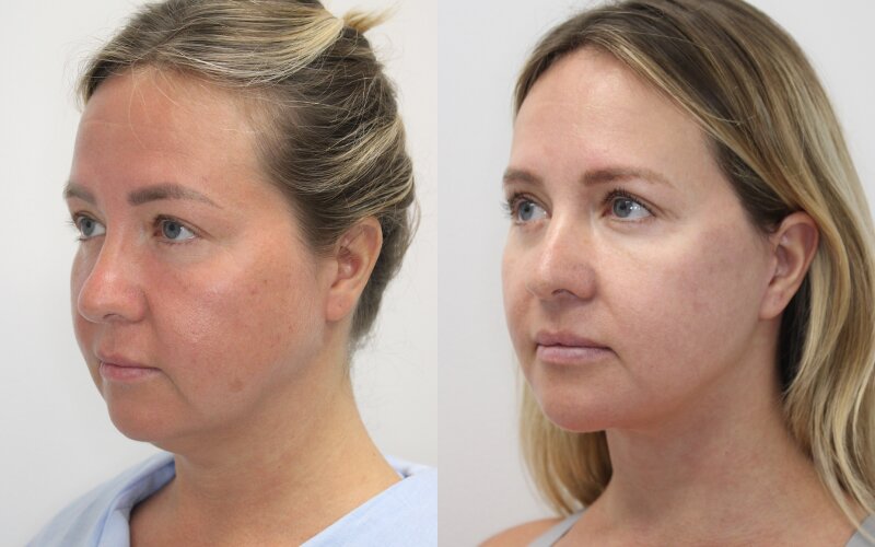 Facelift before and after - after