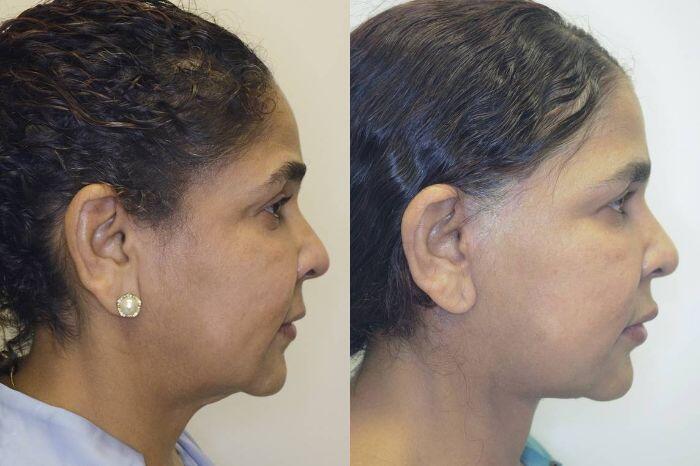 Facelift before and after - after