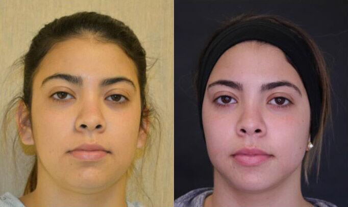 Liposuction before and after - after