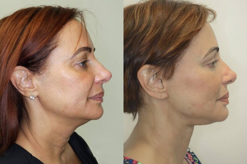 Facelift before and after - after