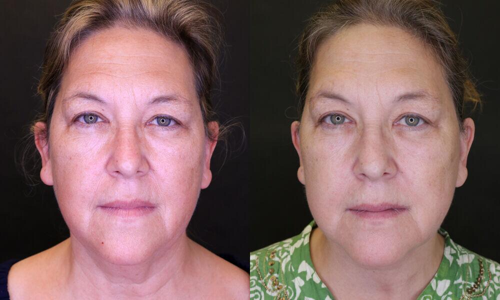 Facelift before and after - after