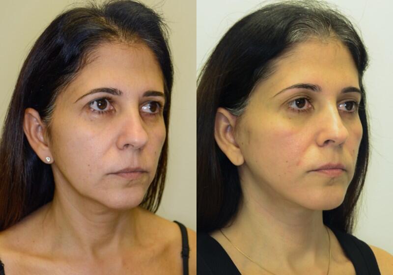 Facelift before and after - after