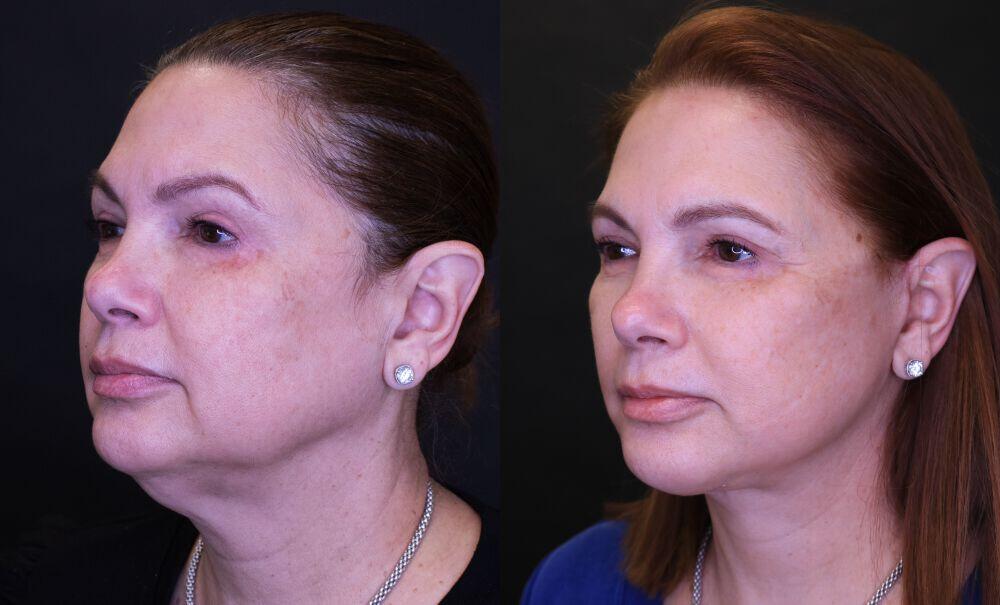 Neck Lift before and after - after