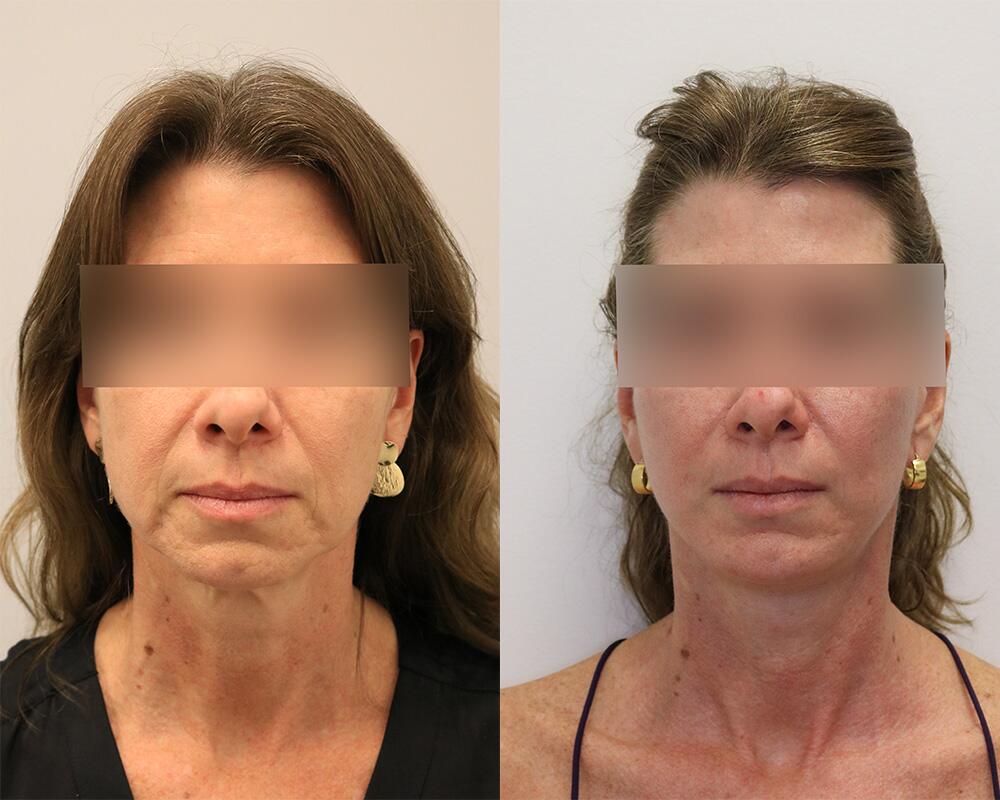 Facelift before and after - after