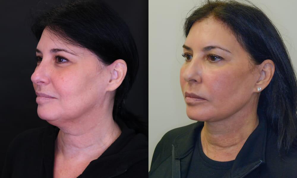 Neck Lift before and after - after