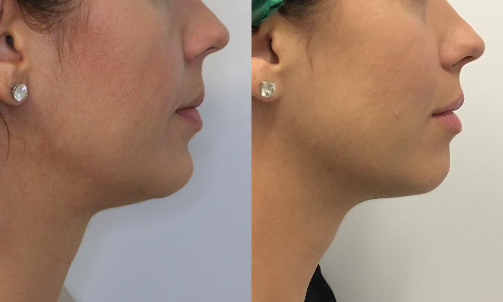 Chin before and after - after