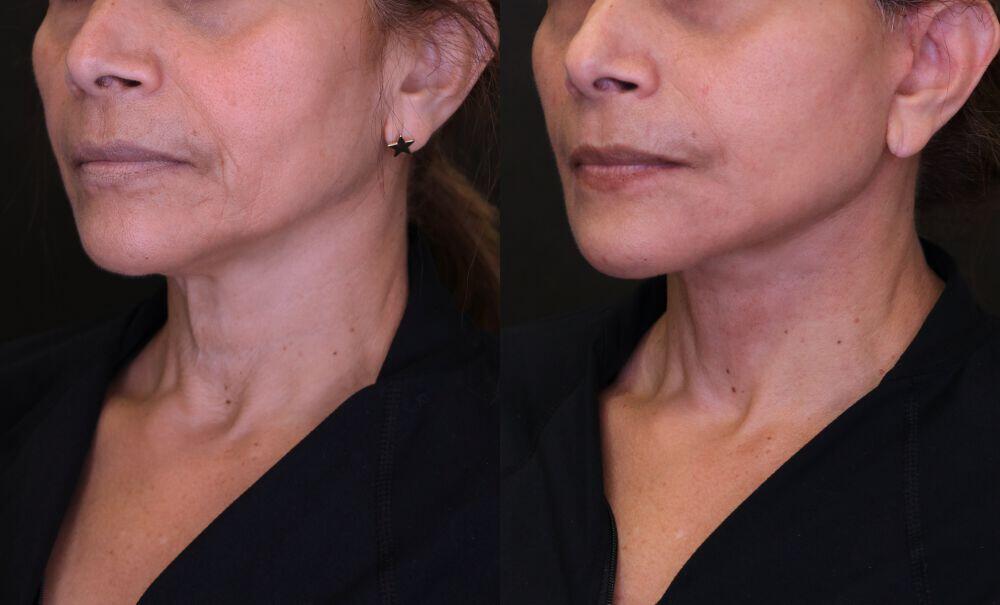 Neck Lift before and after - after