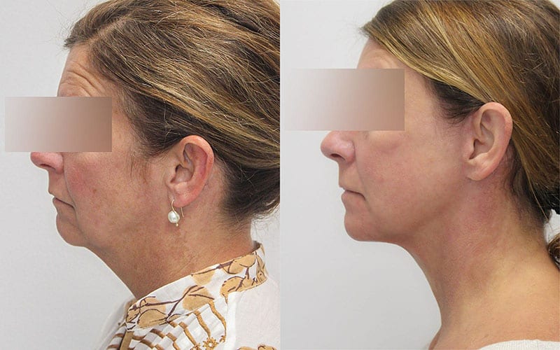 Facelift before and after - after