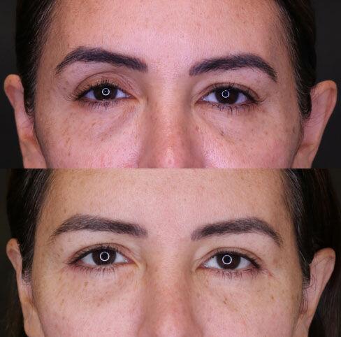 Blepharoplasty before and after - after