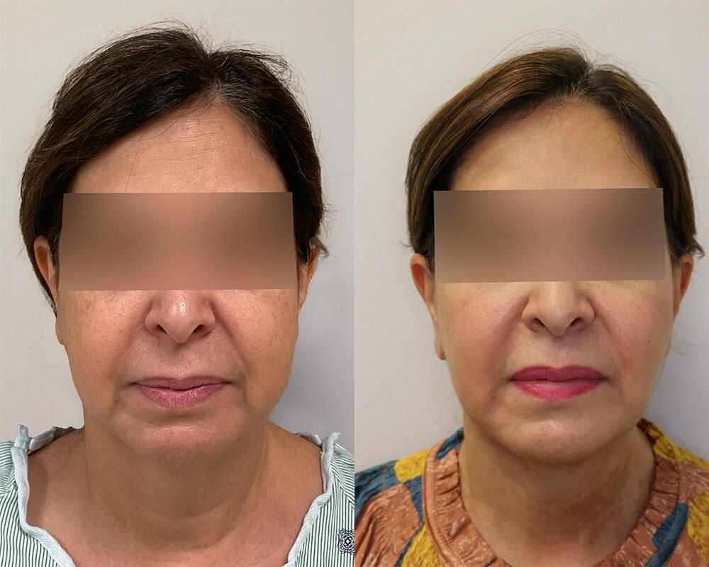 Facelift before and after - after
