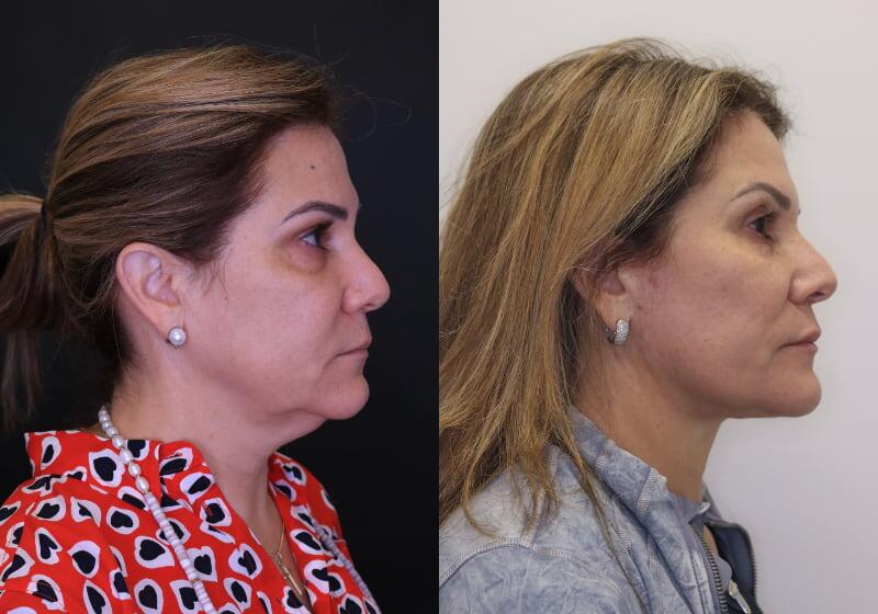 Facelift before and after - after