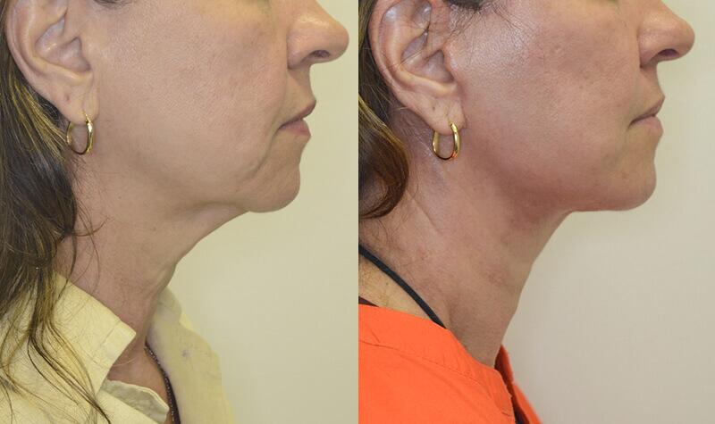 Neck Lift before and after - after