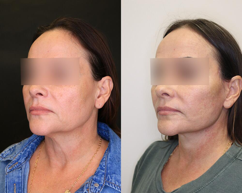 Facelift before and after - after