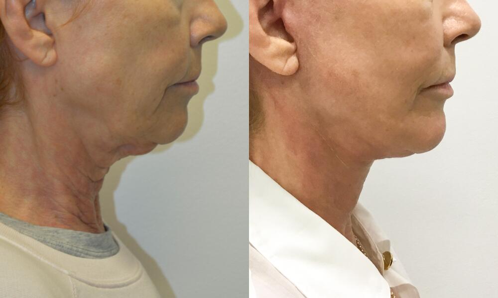 Chin before and after - after