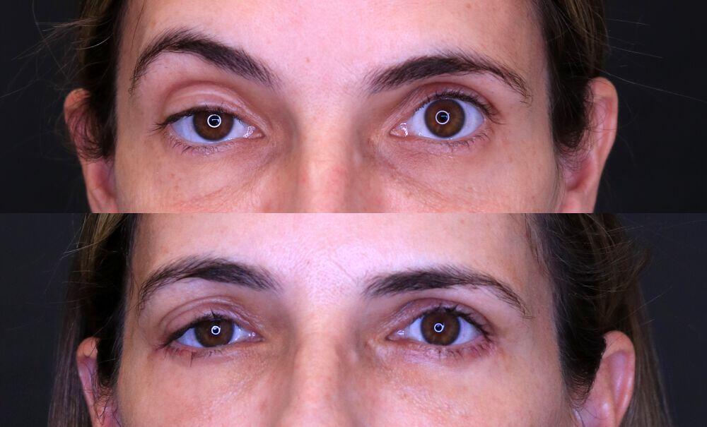 Procedure before and after - after