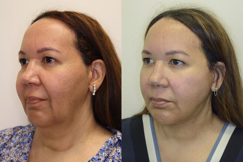 Facelift before and after - after