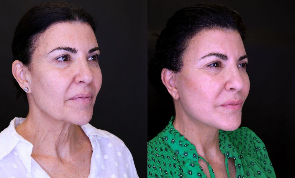 Neck Lift before and after - after