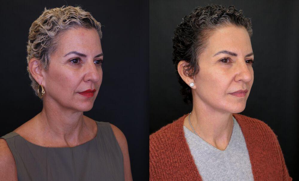 Neck Lift before and after - after