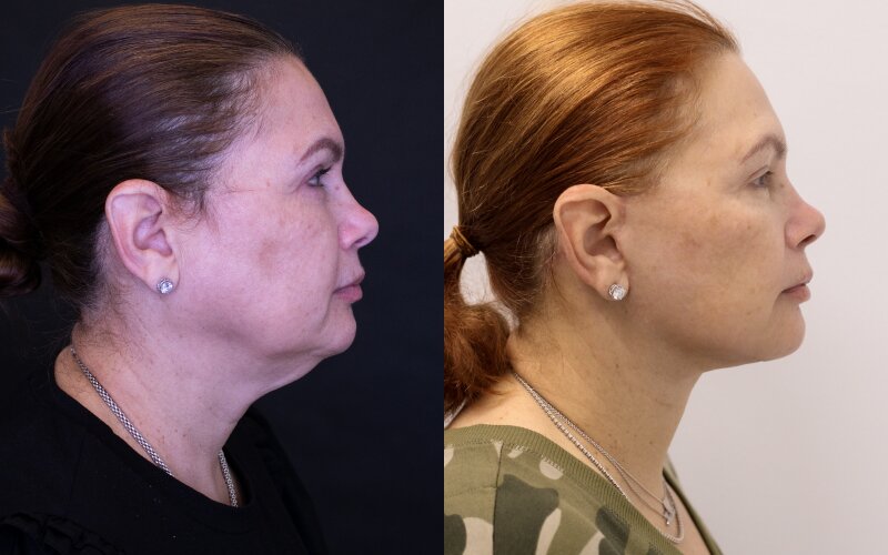 Facelift before and after - after