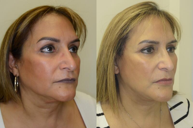 Neck Lift before and after - after