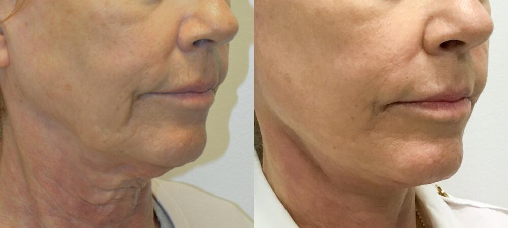 Neck Lift before and after - after