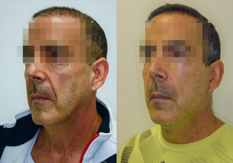 Facelift before and after - after