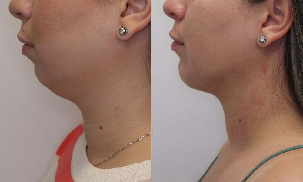Chin before and after - after