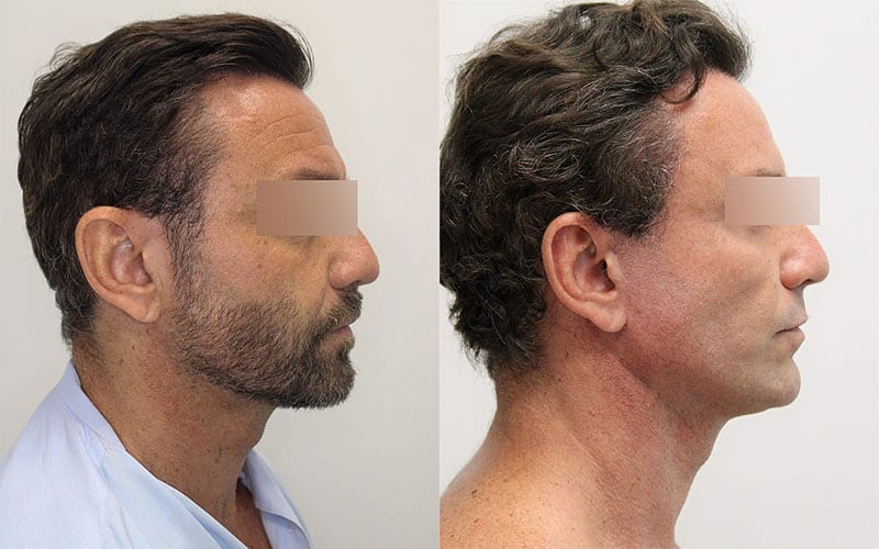 Facelift before and after - after