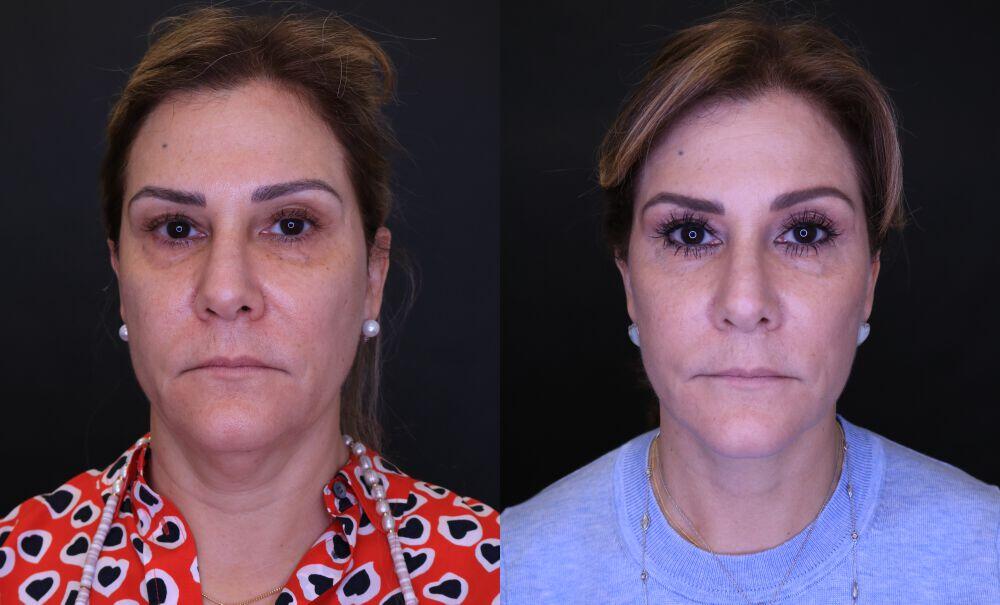 Neck Lift before and after - after