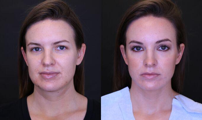 Liposuction before and after - after