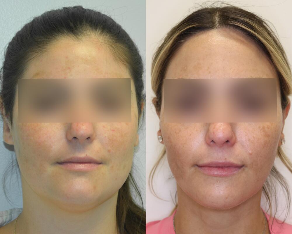 Liposuction before and after - after