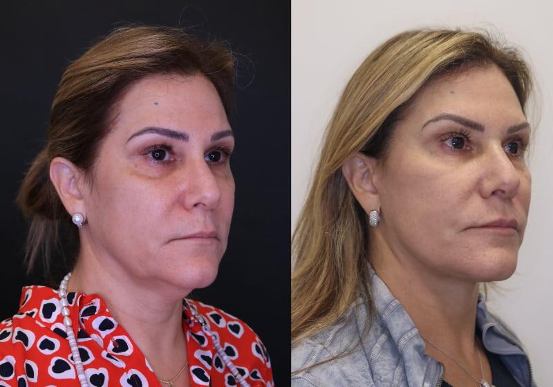 Facelift before and after - before