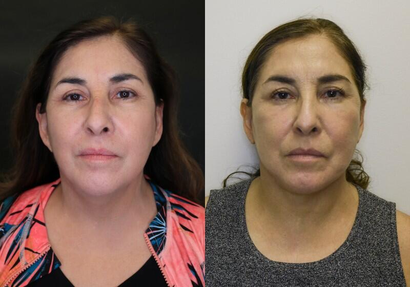 Facelift before and after - before