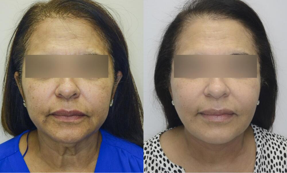 Facelift before and after - before