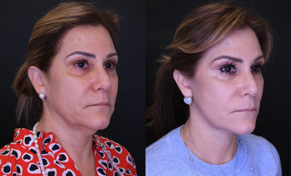 Neck Lift before and after - before