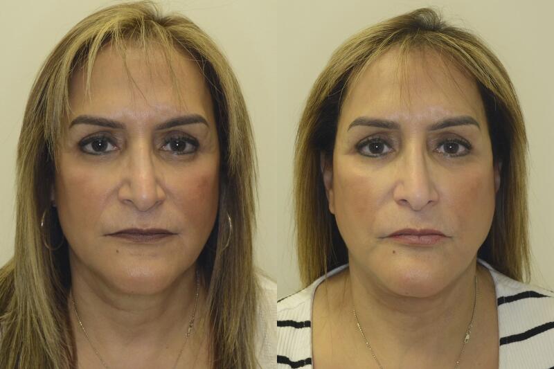 Neck Lift before and after - before