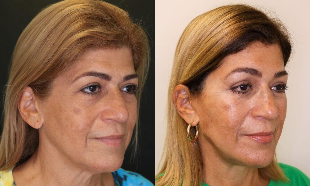 Neck Lift before and after - before
