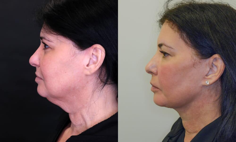 Neck Lift before and after - before