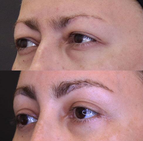 Blepharoplasty before and after - before